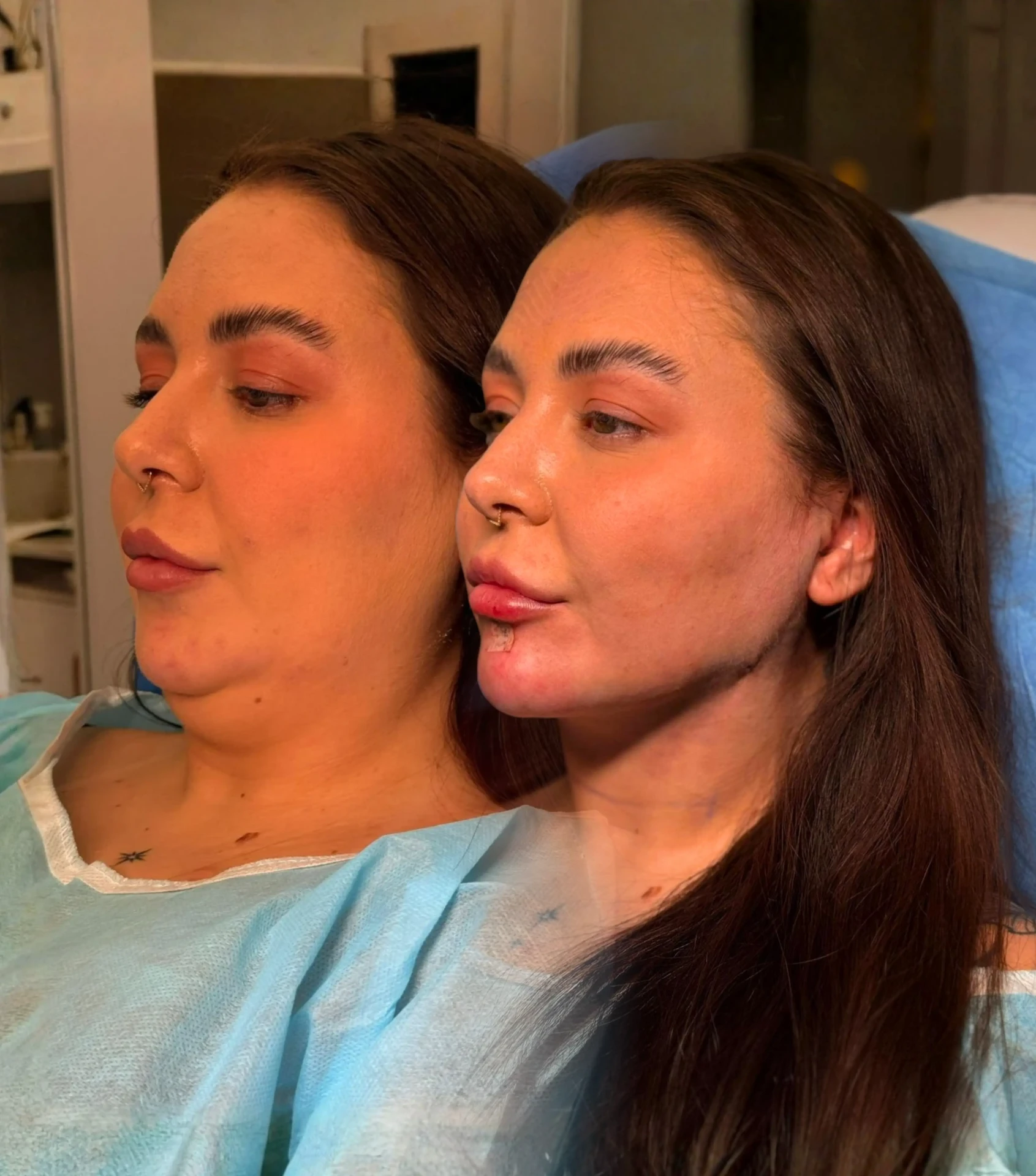 Resultado antes e depois 1